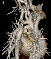 Multidiscip Cardio Annal